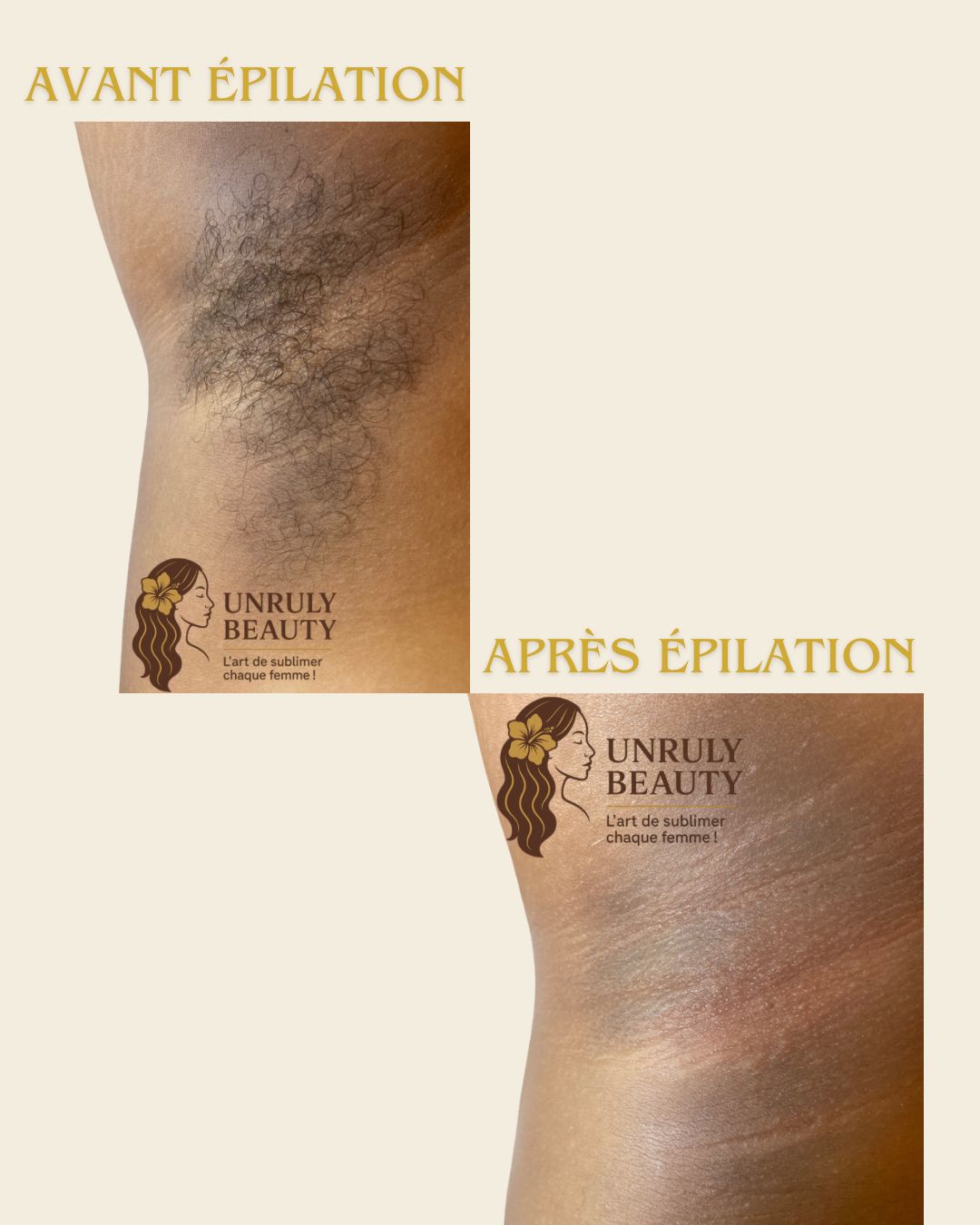 Epilation aisselles