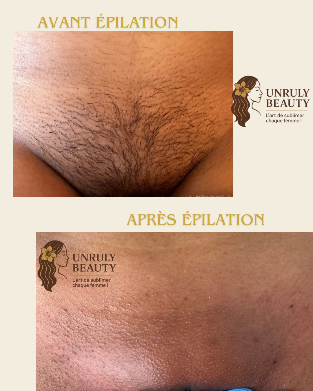 Epilation maillot intégral