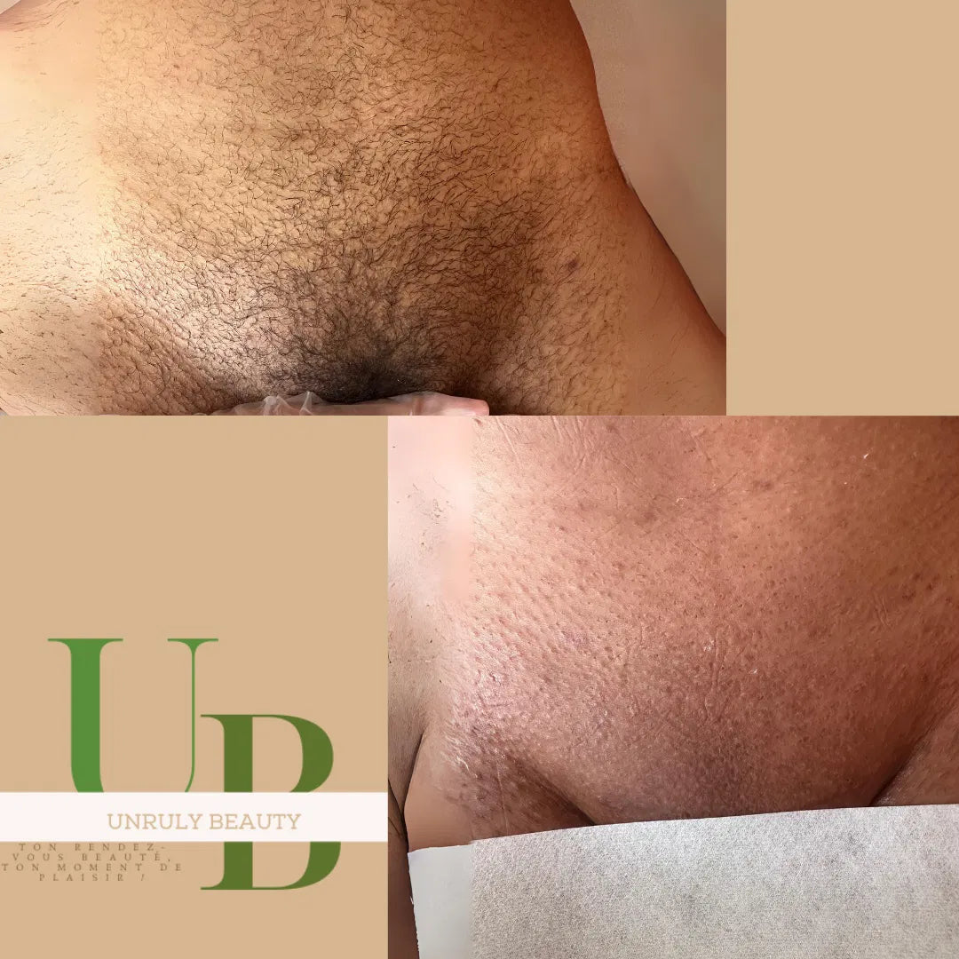 Epilation maillot intégral